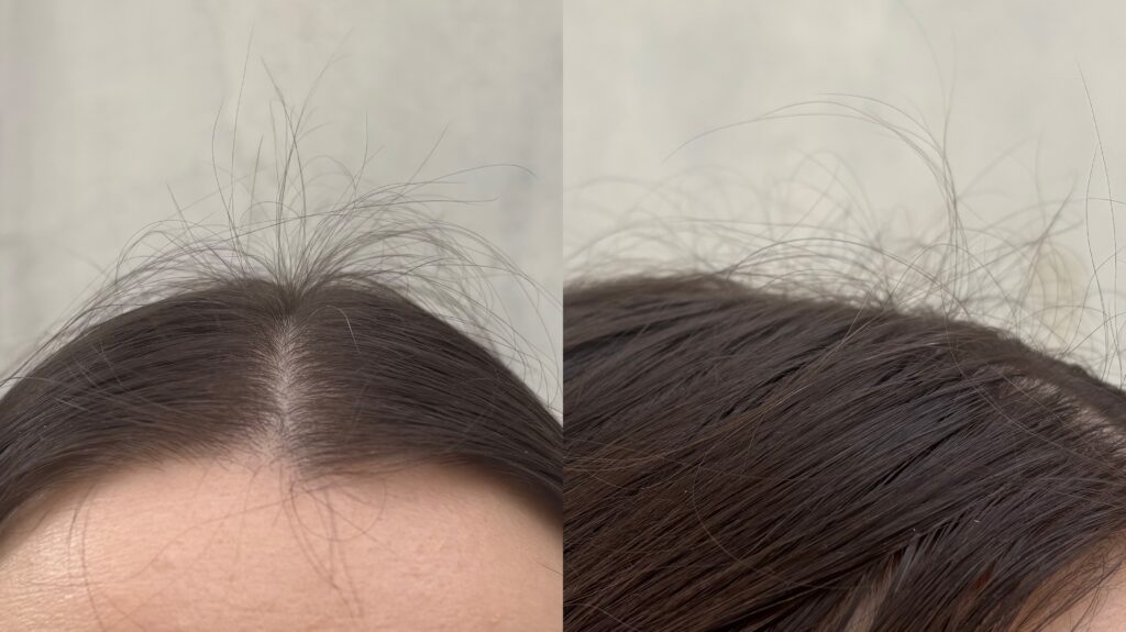 Results after 6 months of using rosemary oil 3 times a week