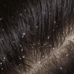 dandruff vs dry scalp