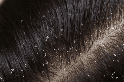 dandruff vs dry scalp