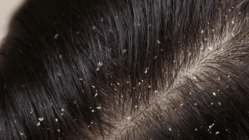 dandruff vs dry scalp