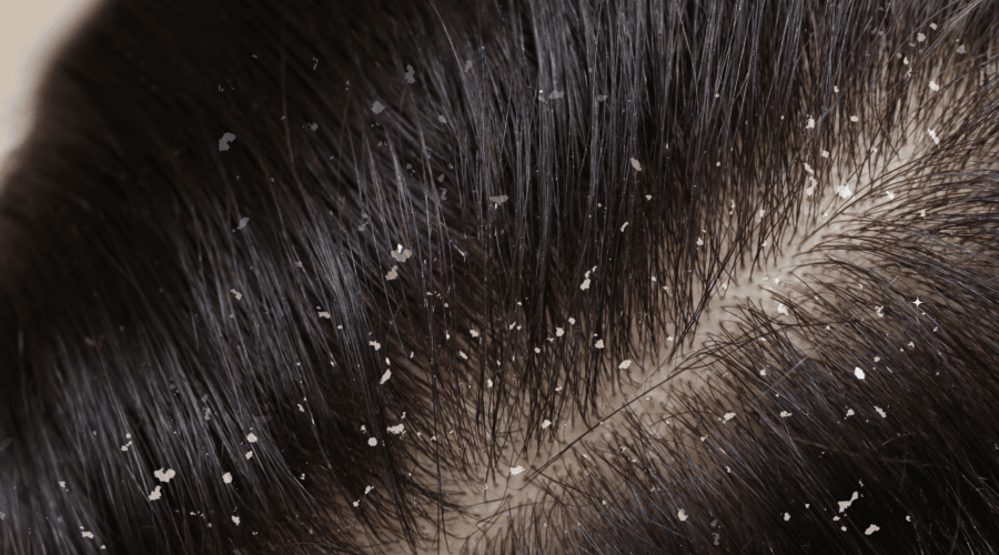 dandruff vs dry scalp