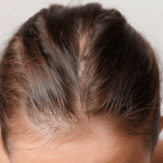 types of hair loss