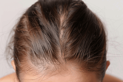types of hair loss