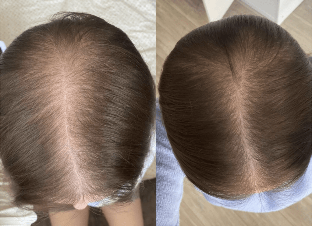 Efekty stosowania minoxidil po 4 miesiącach